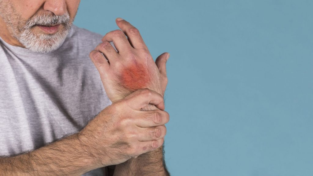 Qué es la flebitis 2 Flebitis Mecánica