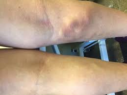 Qué es la flebitis 6 Flebitis Superficial