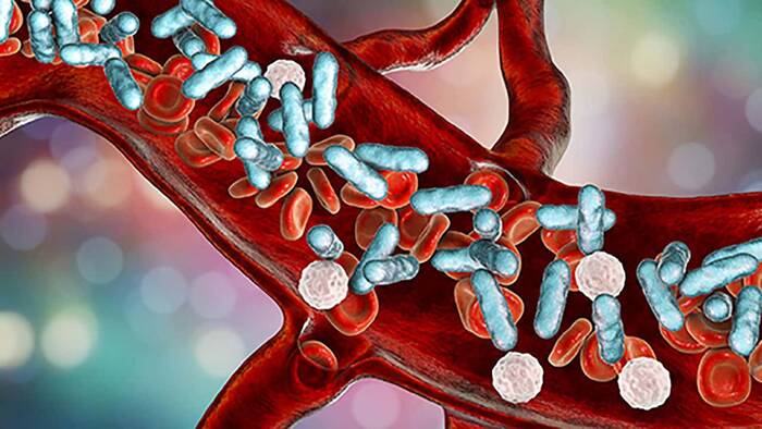 Qué es septicemia 5 Choque Séptico