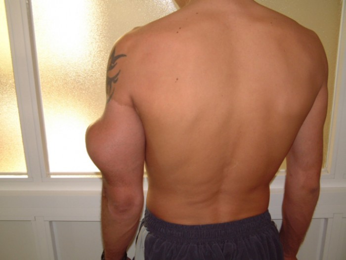 Sarcoma y las causas que lo generan 