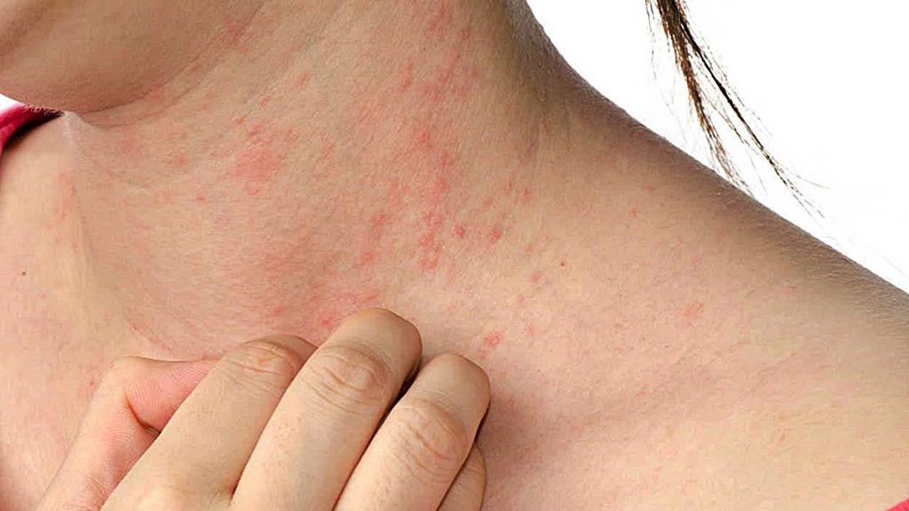 ¿Te pica la espalda? Puede ser un problema de salud 23 Irritaciones y reacciones alérgicas en la piel