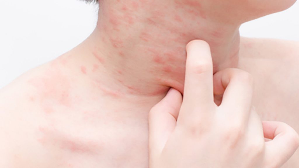 ¿Te pica la espalda? Puede ser un problema de salud 28 Reacciones adversas a medicamentos