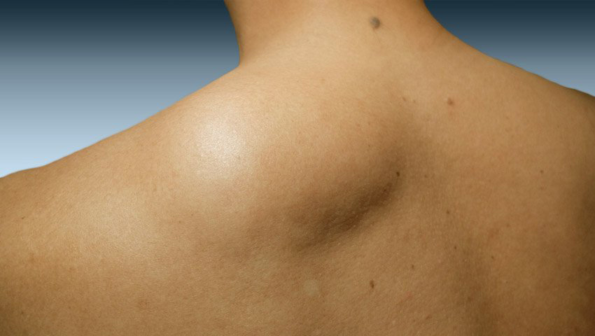 Sarcoma de tejido blando