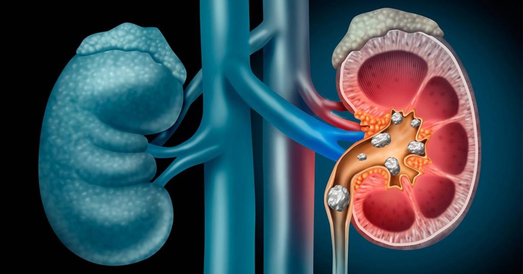 Cómo expulsar una piedra del riñón 3 Cómo expulsar una piedra del riñón