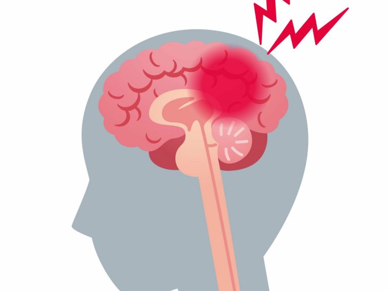 Fumar está directamente relacionado con el riesgo de hemorragia cerebral