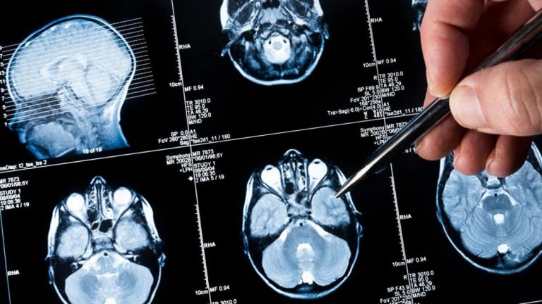 Investigan la posibilidad de diagnosticar tumor cerebral maligno mediante una biopsia líquida