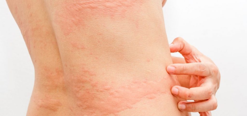 Síntomas Dermatológicos