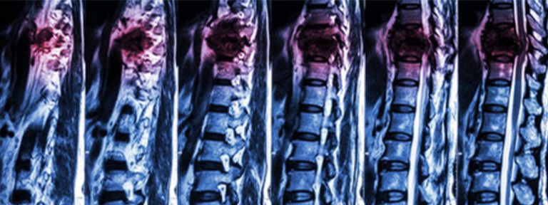Desarrollan un tratamiento para pacientes con una lesión de la médula espinal