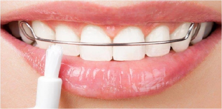 Qué es una ortodoncia 2 Aparatos de ortodoncia removibles o extraíbles