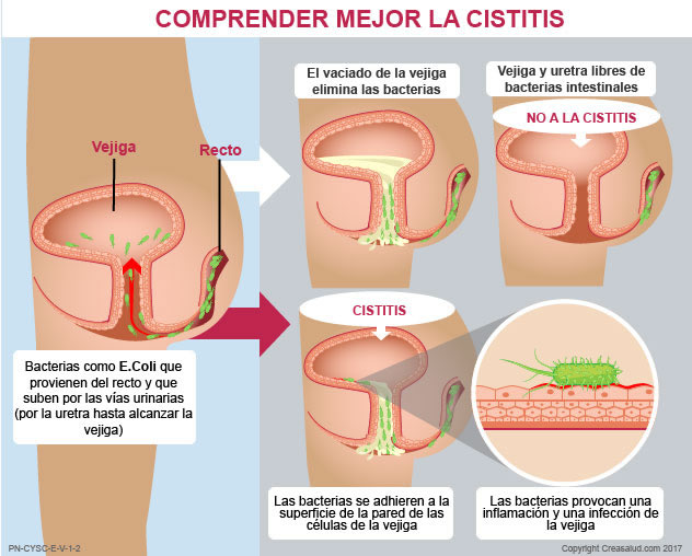 Cómo aliviar la cistitis o infección urinaria 149 Causas de la cistitis