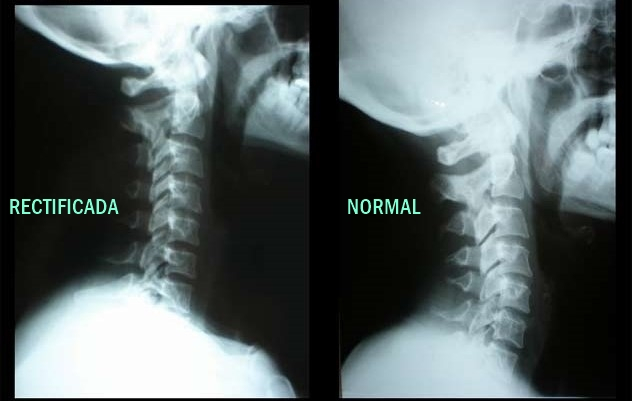 Qué es la lordosis cervical 3 Causas y síntomas de la rectificación de la lordosis cervical