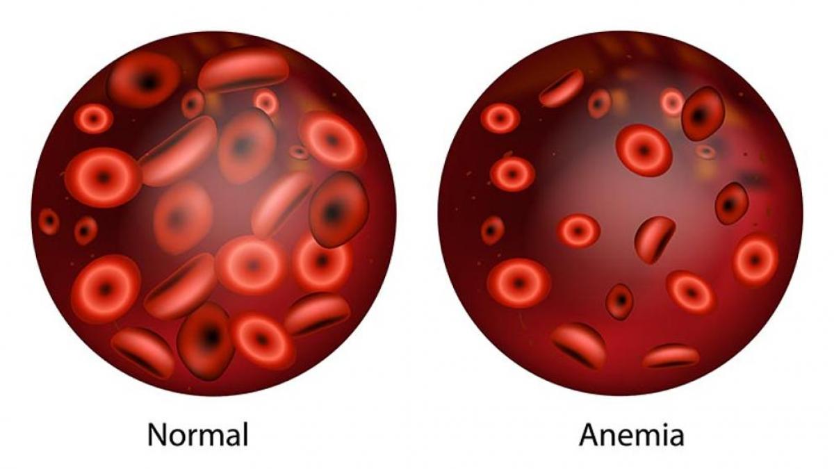 Cómo evitar la anemia 173 La anemia