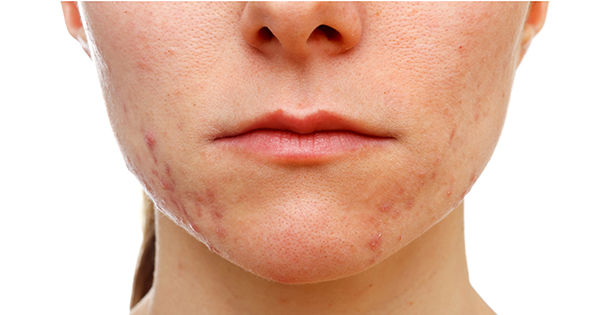 Espinillas, unos detallitos que tienen solución