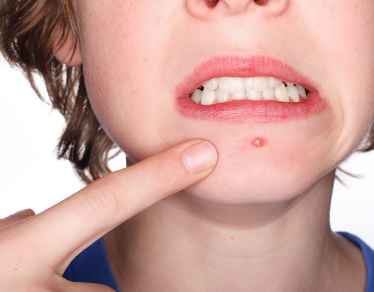 Cómo evitar las espinillas