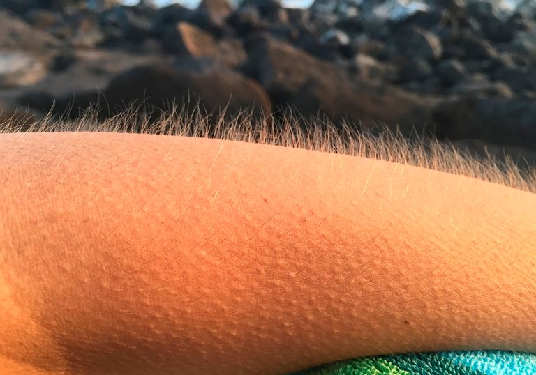 Esto es lo que le pasa a tu cuerpo cuando se te pone la 'carne de gallina'