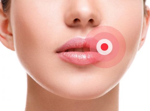 Herpes-LABIAL herpes labial