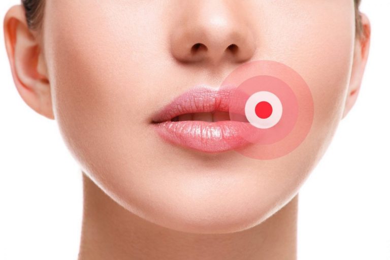 Cómo tratar un herpes labial