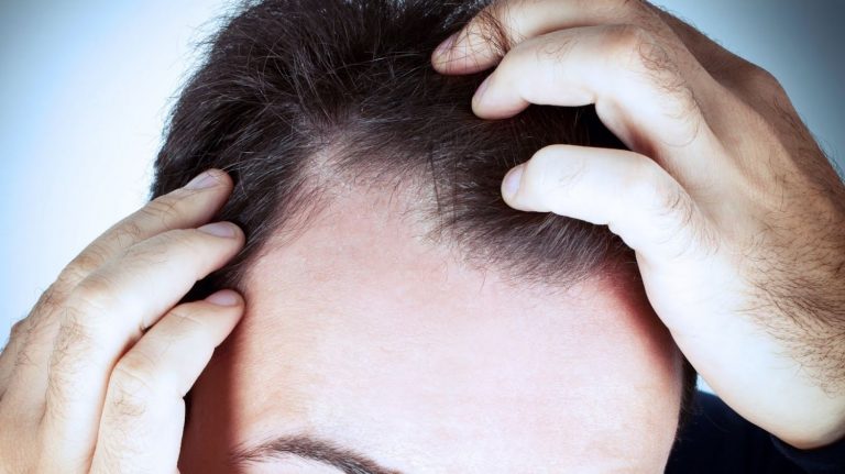 Injerto de pelo: los motivos por los que puede no tener éxito (a pesar de gastarte una pasta)