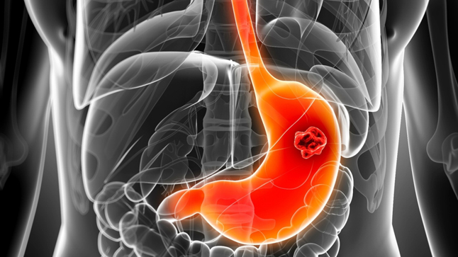 Cáncer de estómago