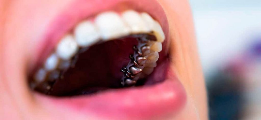 Los brackets linguales