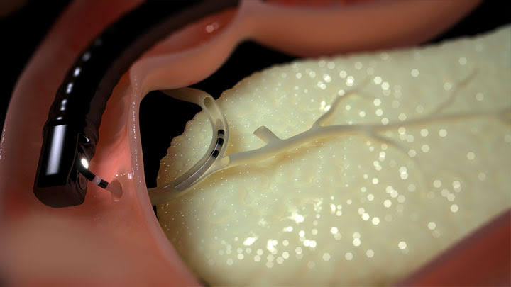 Qué es CPRE en medicina