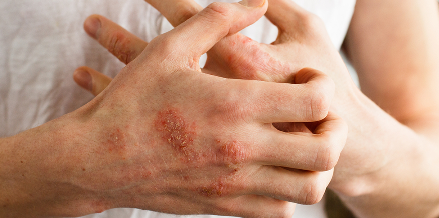 Qué es esclerodermia