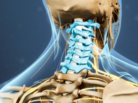 Qué es la lordosis cervical Qué es la lordosis cervical
