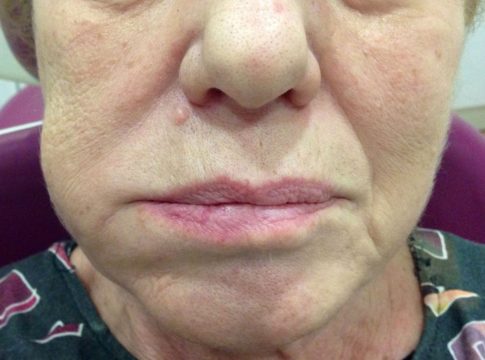 Qué es un flemón Qué es un flemón