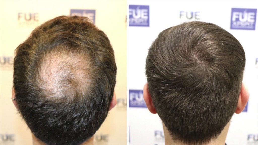 Qué es un injerto de pelo