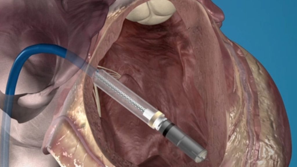 ¿Cómo se implanta un marcapasos?