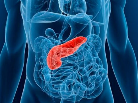 Qué es una pancreatitis y cómo se cura Qué es una pancreatitis y cómo se cura