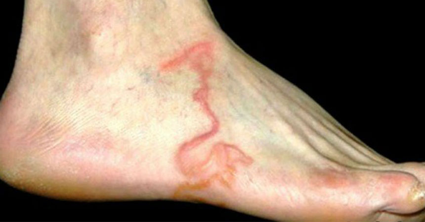 Qué es una tenia 1 Qué es una tenia