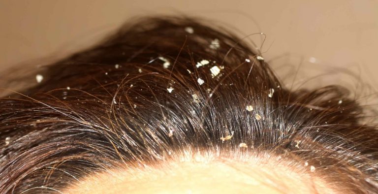 Remedios caseros para eliminar la caspa de tu pelo