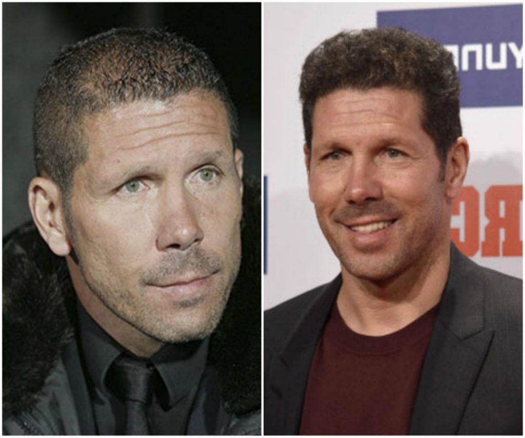 Rafa Nadal y otros que recurrieron al injerto de pelo para no parecer "bolas de boliche" 