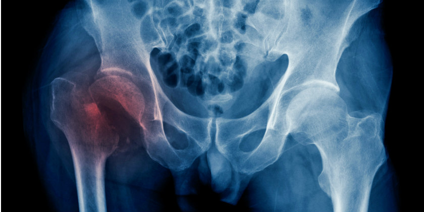 Síntomas de una fractura