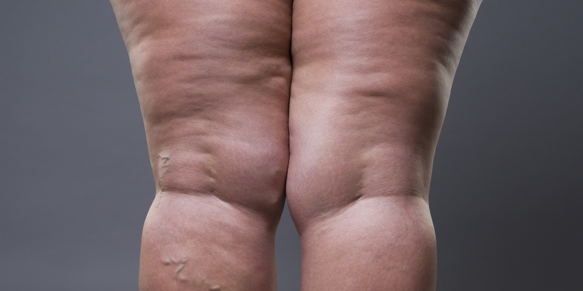 Síntomas y diagnostico del lipedema
