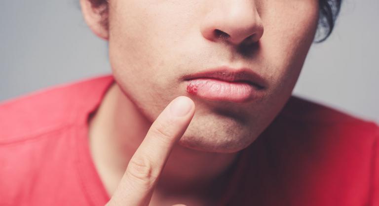 ¿Cuáles son las fases de herpes labial?