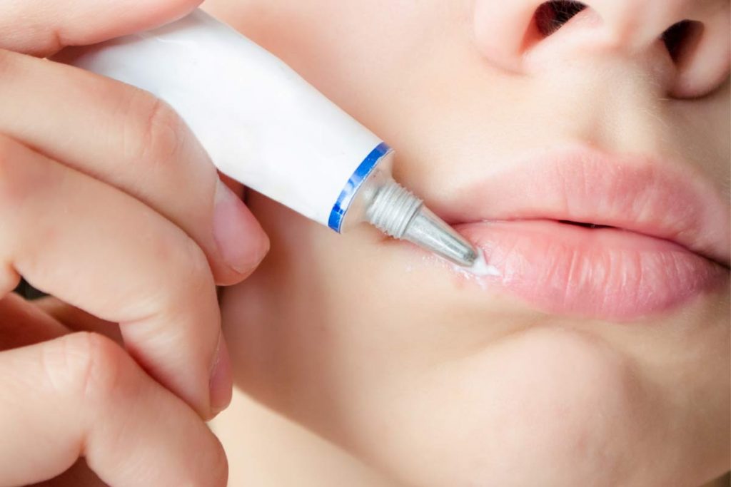 ¿Cuáles son los remedios para tratar el herpes labial?