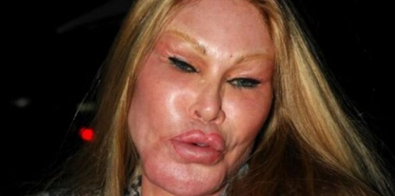 Cirujanos a los que se les fue la mano con la silicona