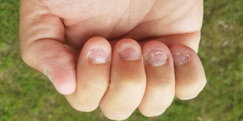 ¿Por qué es importante detener el hábito de comerse las uñas?