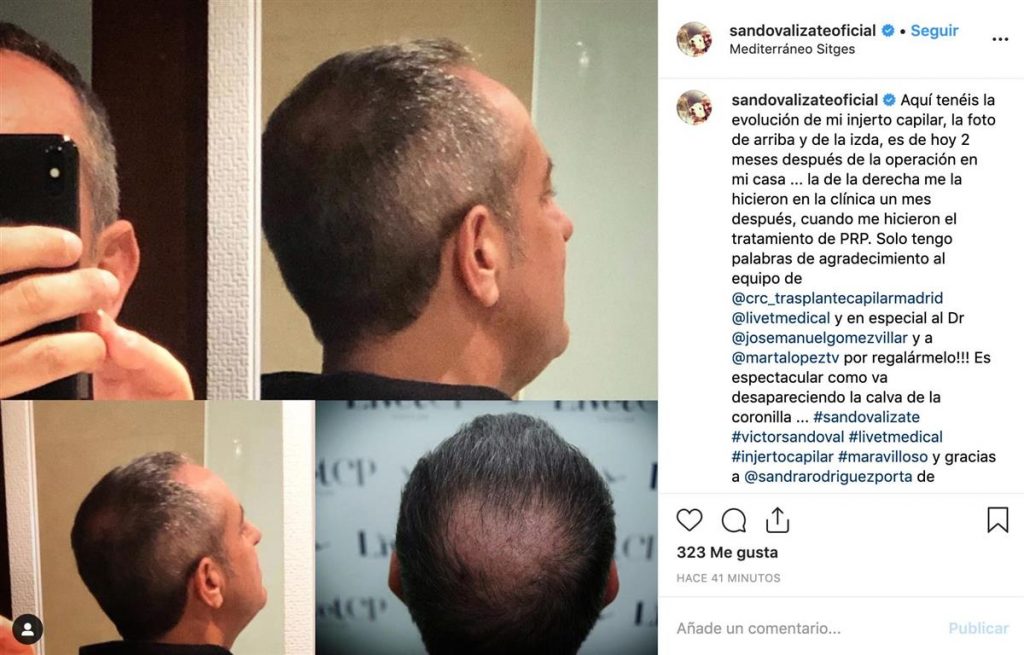 Rafa Nadal y otros que recurrieron al injerto de pelo para no parecer "bolas de boliche" 