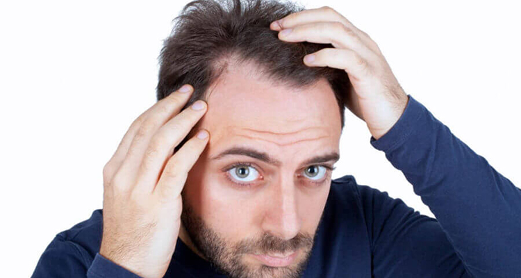 10 señales de que te estás quedando calvo 05