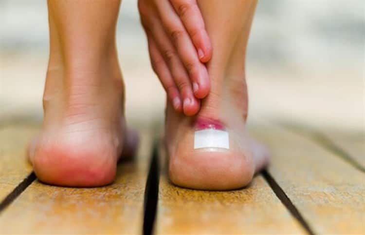 ¿Por qué aparece una ampolla?