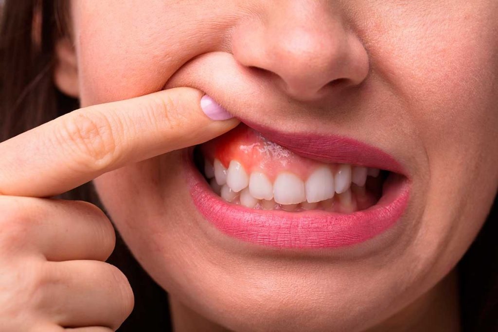 Hierro: señales que te avisan que podrías tener anemia 13 Afectaciones en la boca