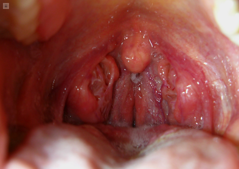 Qué es la faringitis 150 Causas de la faringitis