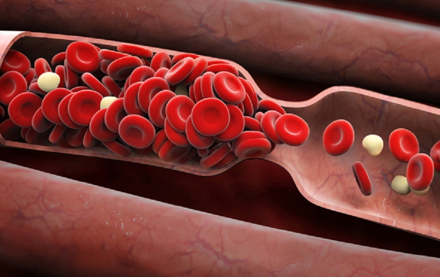 Qué es un trombo 50 Causas de un trombo