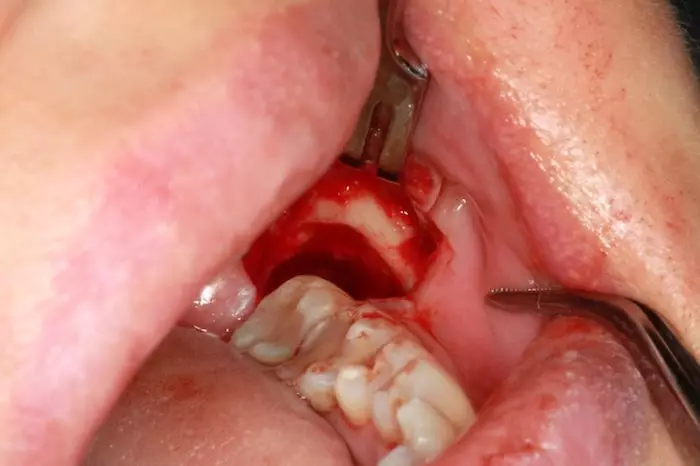 Cómo aliviar el dolor cuando te han sacado una muela 210 ¿Cómo parar el sangrado luego de una extracción de muela?