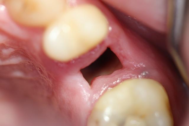 Cómo aliviar el dolor cuando te han sacado una muela 214 ¿Qué es la alveolitis seca?