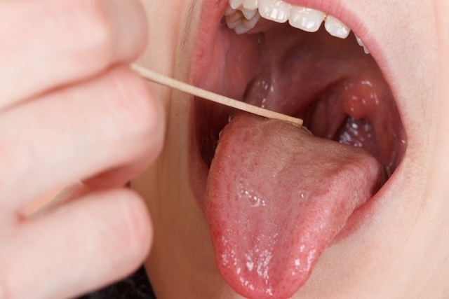 Qué es la faringitis 154 Diagnostico de la faringitis