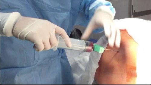 ¿Cómo ser donante de médula ósea?